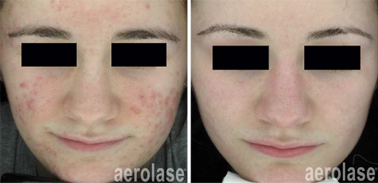 NeoClear_Acne_-_3_Months_After_5_Treatments_-_David_Goldberg_MD_540x