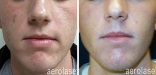 aerolase-kevin-pinski-acne-skin-rejuvenation_540x