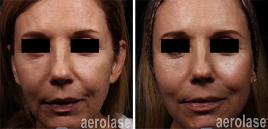 aerolase-neoskin-skin-rejuvenation-after-2-treatments-combined-with-threads-and-filler-one-aesthetics_540x