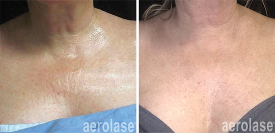 aerolase-neoskin-skin-rejuvenation-after-4-treatments-jason-emer_540x
