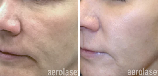 aerolase-skin-rejuvenation-before-after-kevin-pinski-4-treatments_540x