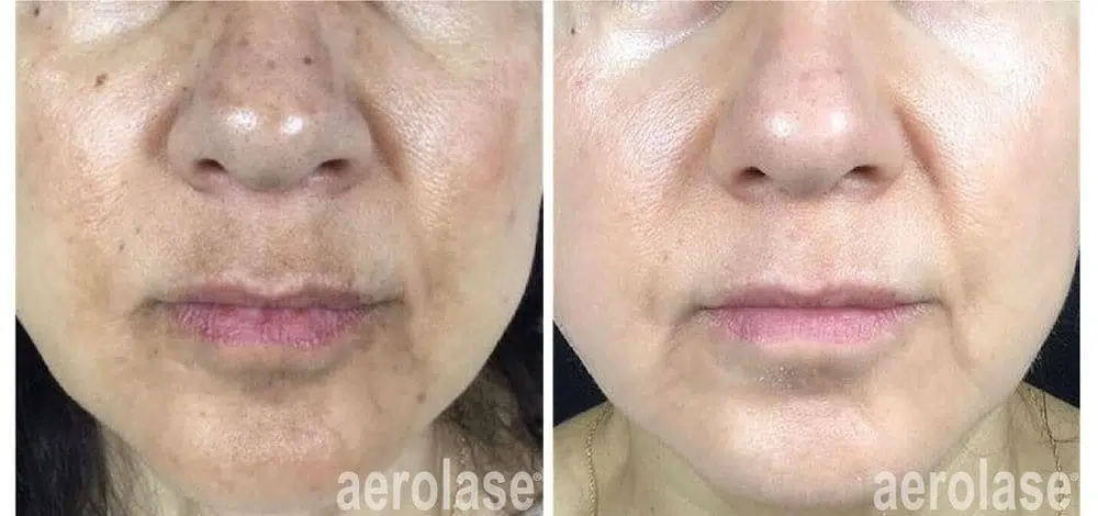 melasma-avanti-before-and-after-copy