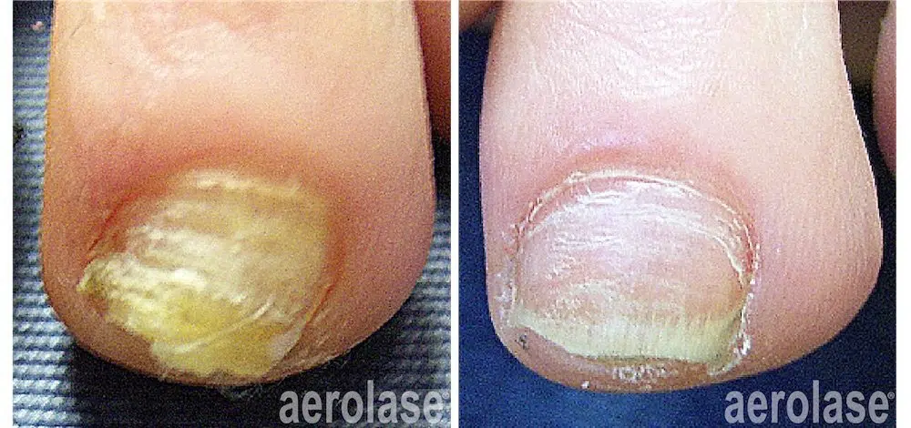 nail-fungus-before-and-after-copy