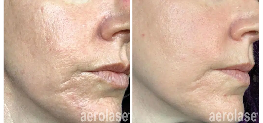skin-rejuvenation-before-and-after