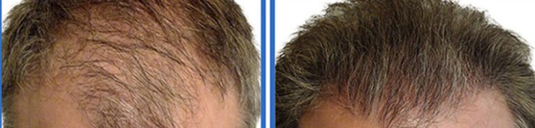 before vs after hair transplant in Evansville Indiana