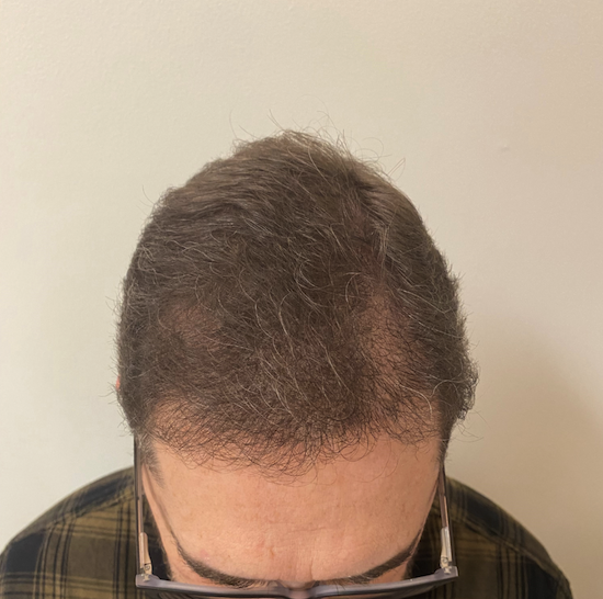 hair loss treatments results in Evansville, IN