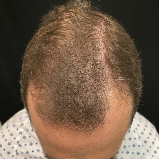 hair loss treatments results in Evansville, Indiana