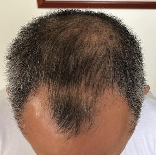 hair restoration results in Evansville, IN