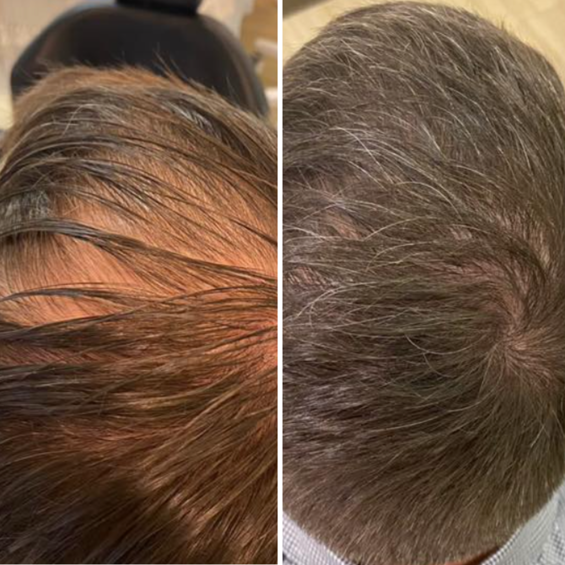 hair transplant before after