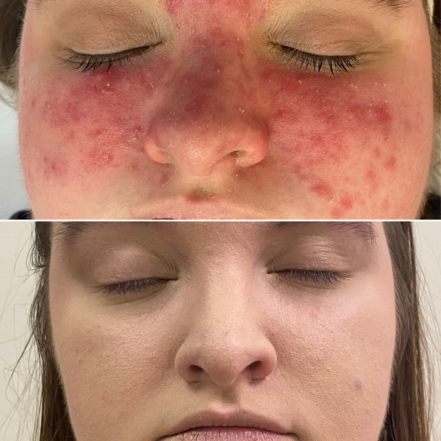 acne clinic evansville indiana