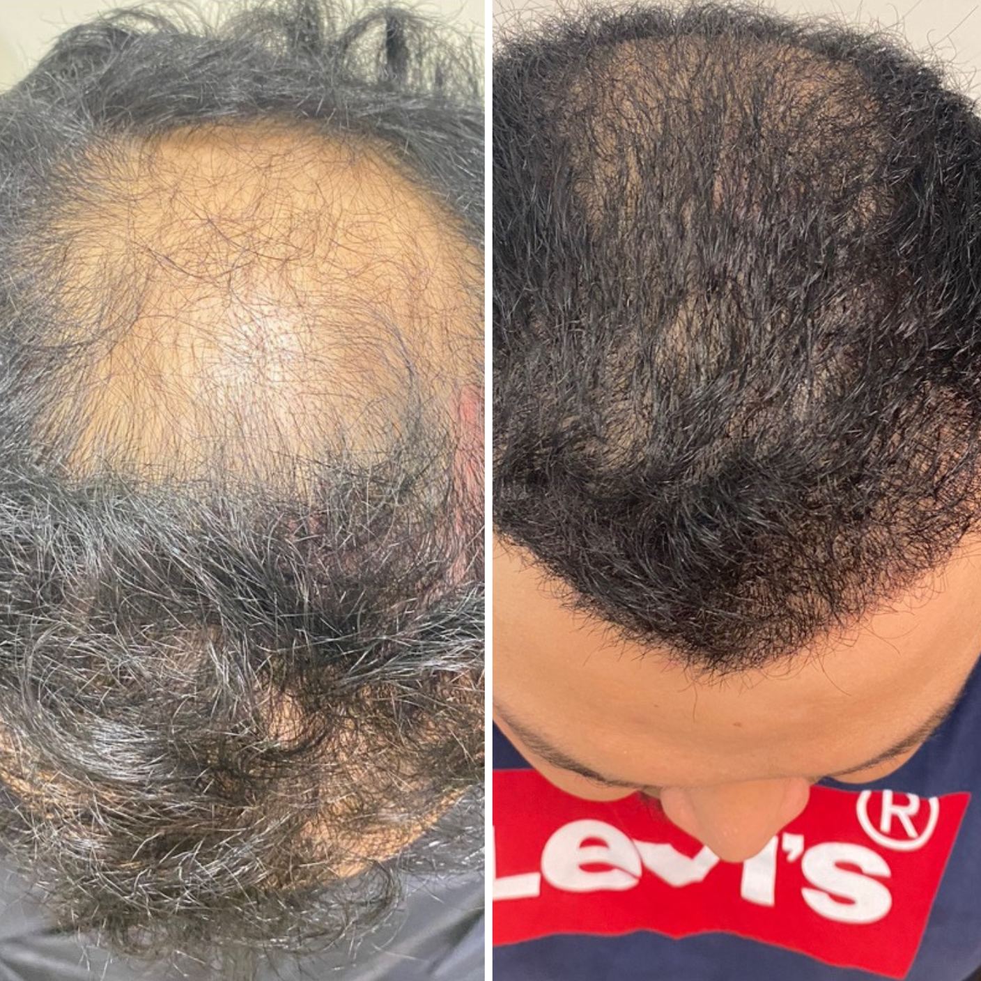 hair transplant evansville IN