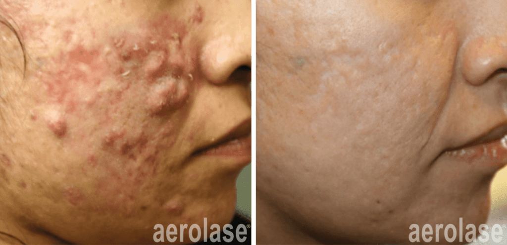 acne clinic evansville in