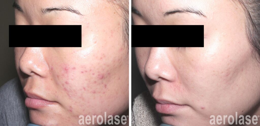 acne clinic evansville in