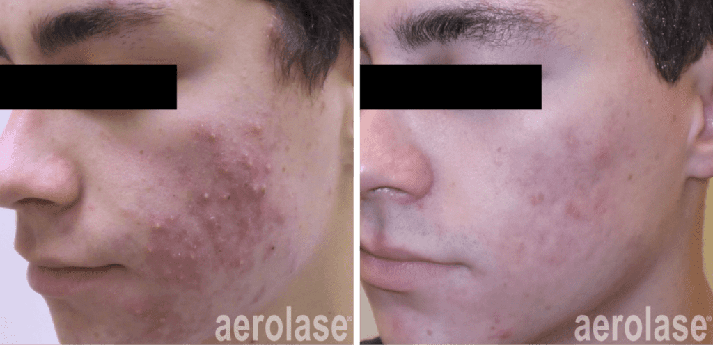 acne clinic evansville in