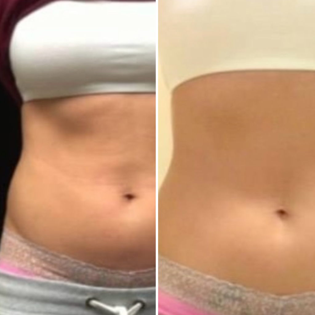 coolsculpting evansville in