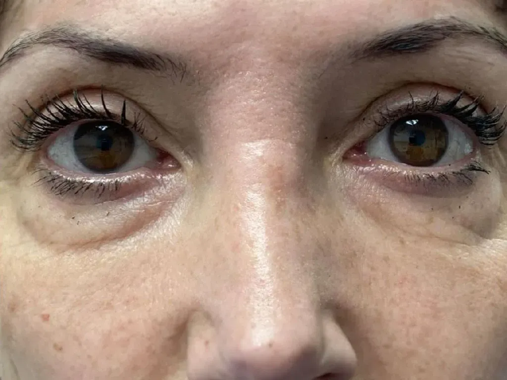 Eyelid Before Eyelid Before