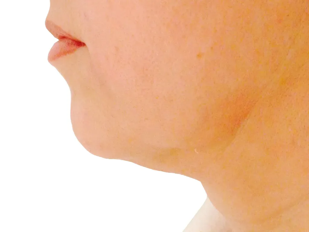 Jawline Before Jawline Before